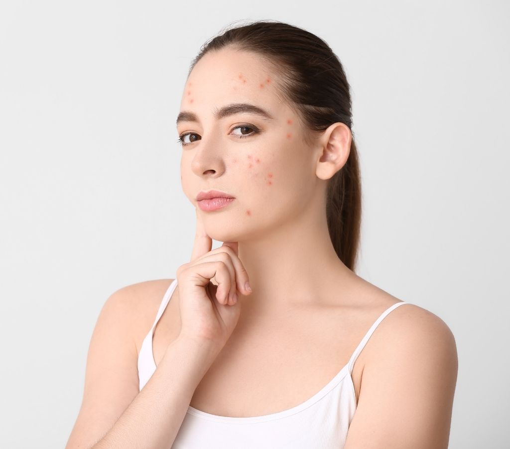 trattamento acne cosenza