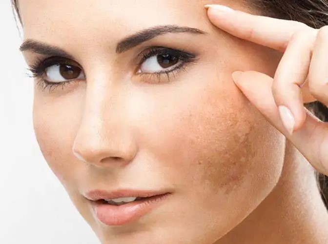 trattamento macchie viso cosenza